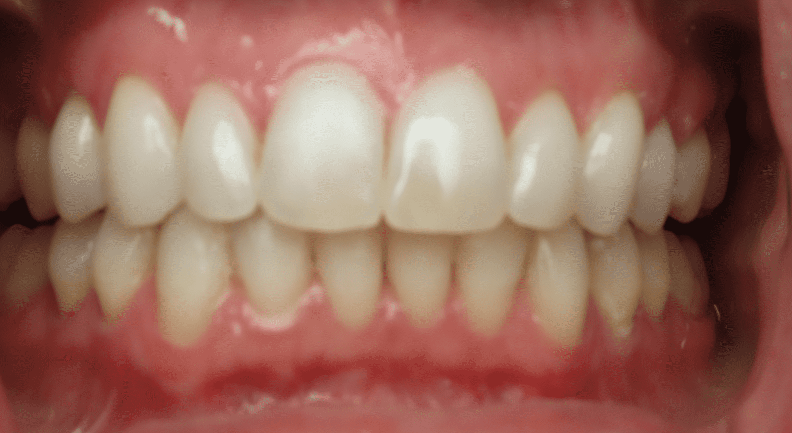 teeth-after-photo